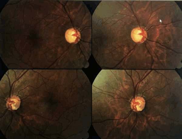 Descolamento da Retina  Oculari Hospital Oftalmológico